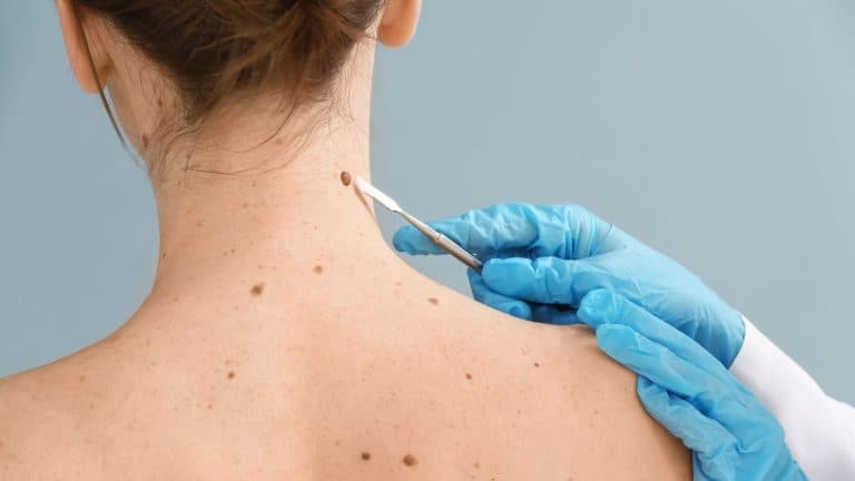 Cáncer de piel: las señales que tu cuerpo estaría intentando mostrarte